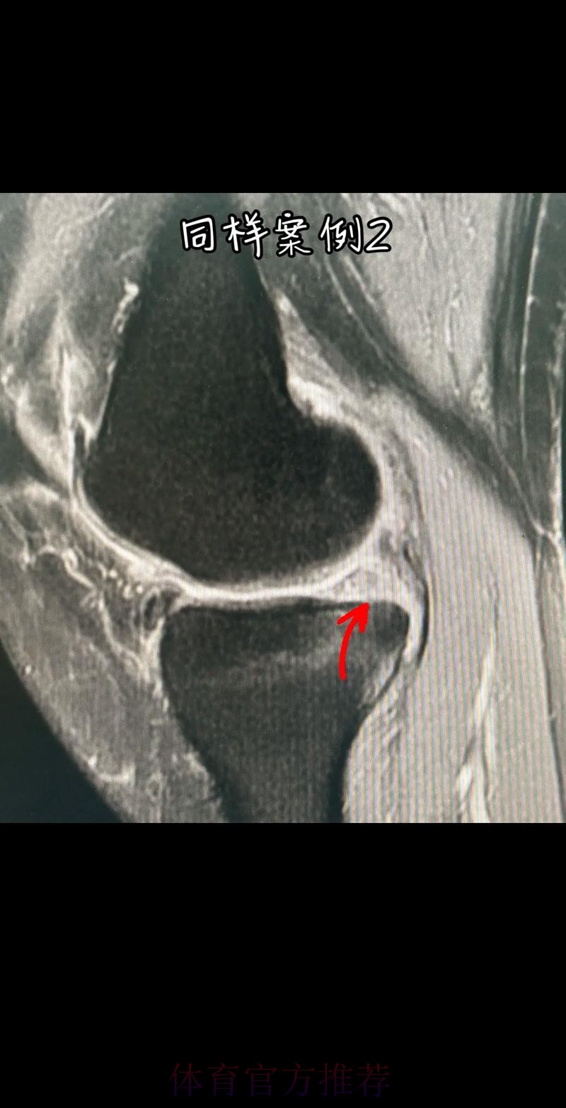 官方:阿拉巴左膝内侧半月板撕裂 预计伤缺6-8周 官方:阿拉巴左膝内侧半月板撕裂 预计伤缺6-8周